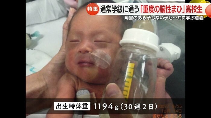 重度の脳性まひと診断