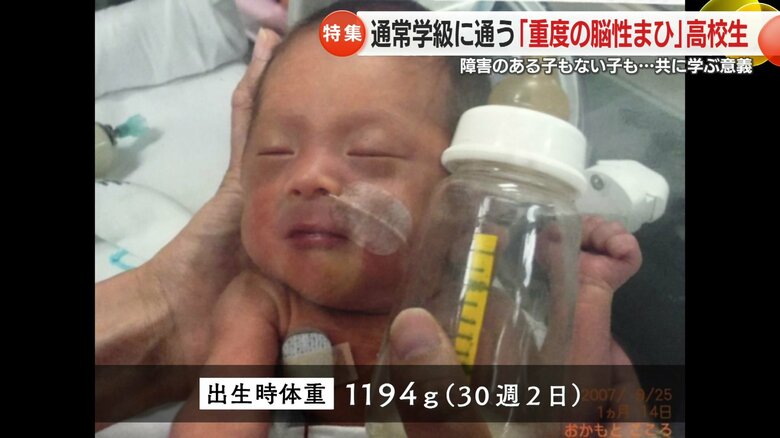 重度の脳性まひと診断