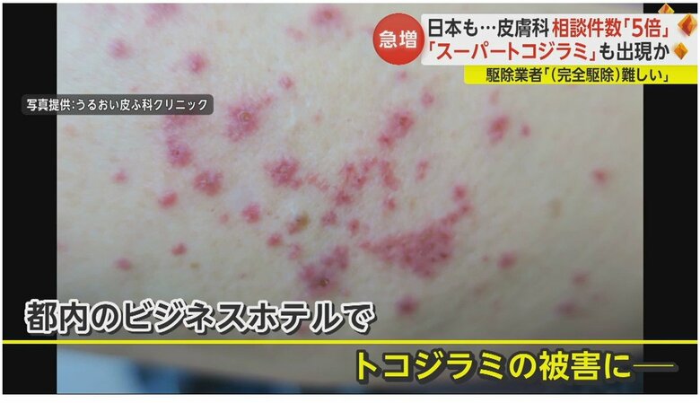 ベッドで寝ていた時に刺され、太ももに赤い発疹が