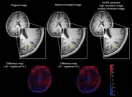【新潟医療福祉大学】「撮り直し」の負担を軽減！AIでMRIの“ぶれ”を自動補正
