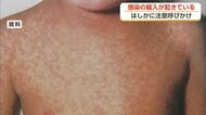 はしか感染が全国で急増　富山県が予防接種の確認を呼びかけ