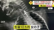 「神様からの贈り物」“十字架”を飲み込んだ生後10ヵ月の女の子　手術は難航も無事成功　ペルー