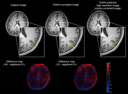 【新潟医療福祉大学】「撮り直し」の負担を軽減！AIでMRIの“ぶれ”を自動補正