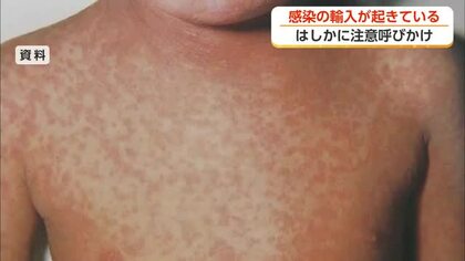 はしか感染が全国で急増　富山県が予防接種の確認を呼びかけ