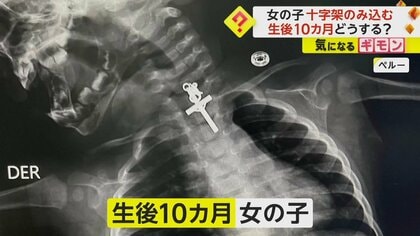 「神様からの贈り物」“十字架”を飲み込んだ生後10ヵ月の女の子　手術は難航も無事成功　ペルー