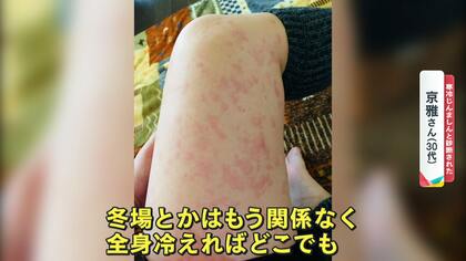 腫れとかゆみが襲う「寒冷じんましん」の患者数去年比1.5倍に…2歳児も発症してしまうケースと慢性化のリスク