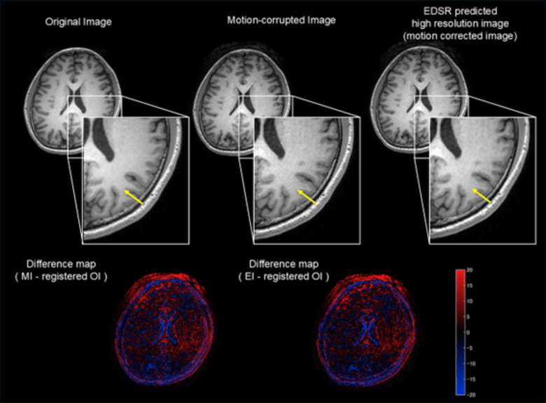【新潟医療福祉大学】「撮り直し」の負担を軽減！AIでMRIの“ぶれ”を自動補正