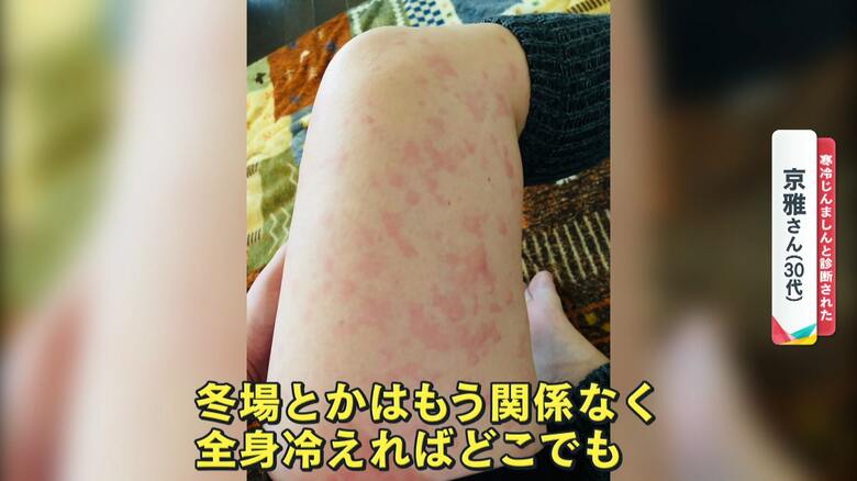 腫れとかゆみが襲う「寒冷じんましん」の患者数去年比1.5倍に…2歳児も発症してしまうケースと慢性化のリスク｜FNNプライムオンライン