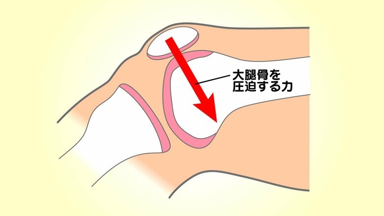 お皿が大腿骨を圧迫