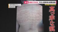 「2000円で背中の脱毛ができる」安さにひかれ…被害女性が語る「本質を見た方がよかった」　サロン経営者ら書類送検【大阪発】