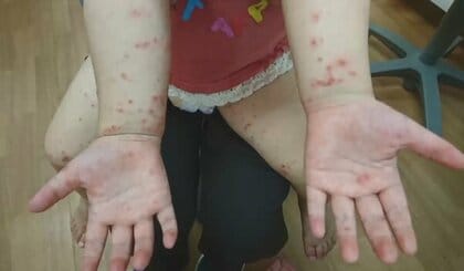発疹や発熱…「手足口病」急増　3年ぶり警報レベルに　赤ちゃんの“おむつ替え”にも注意