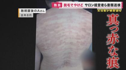 「2000円で背中の脱毛ができる」安さにひかれ…被害女性が語る「本質を見た方がよかった」　サロン経営者ら書類送検【大阪発】