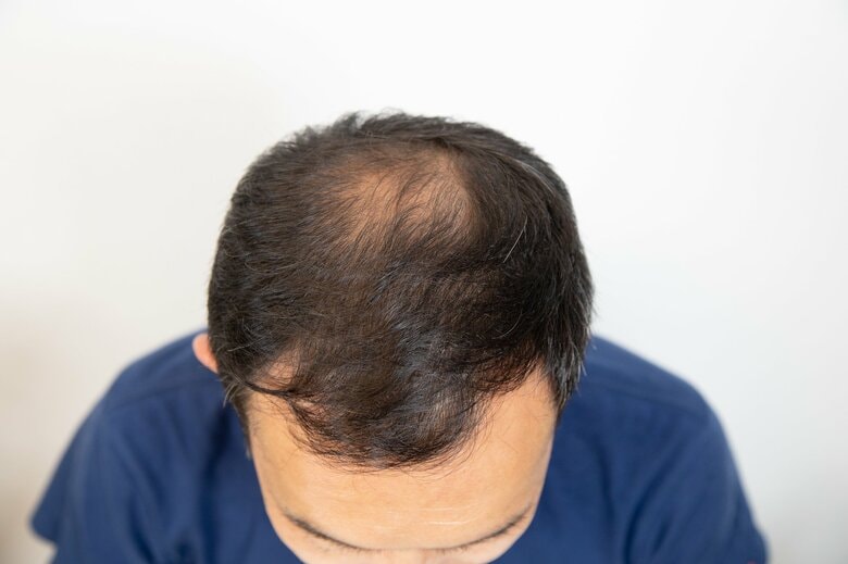 AGAは確実に進行していく