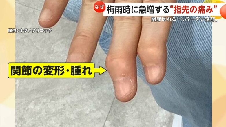 関節の変形や腫れが出る「ヘバーデン結節」