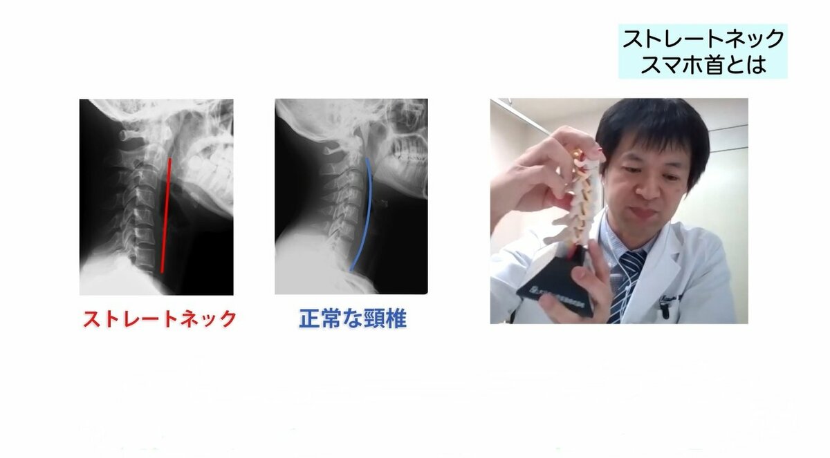 スマホの使いすぎなどが原因の ストレートネック 自己診断法と3つの予防ストレッチを専門医が解説 名医のいる相談室 Fnnプライムオンライン