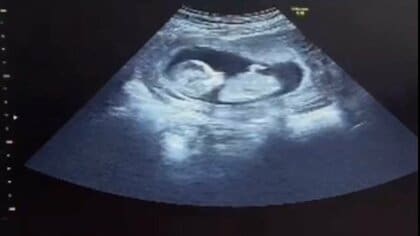 子宮がんで突然の「産めない」宣告　残された5つの受精卵、夫婦が選んだジョージアでの代理出産 