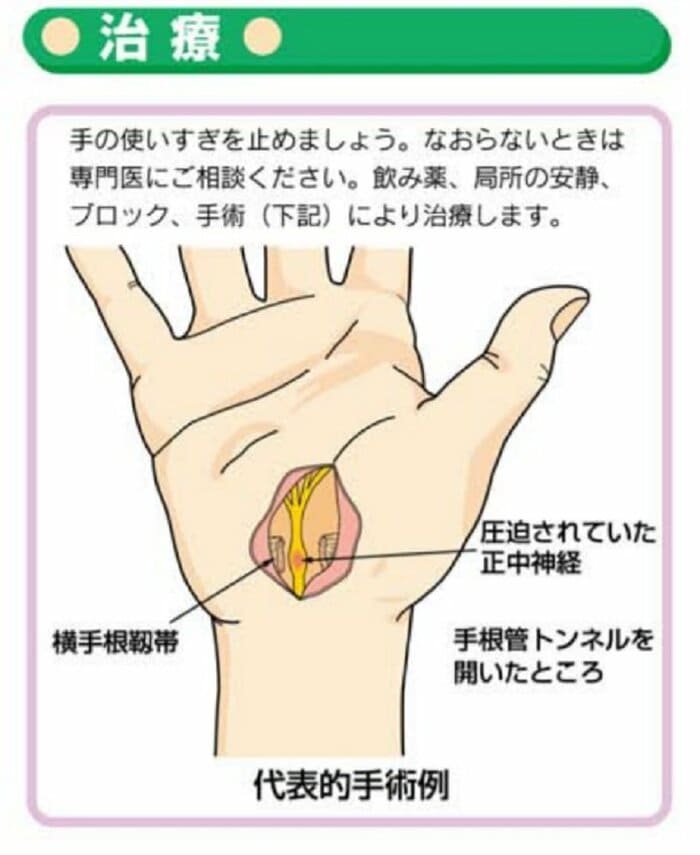 手根管症候群 治療(画像提供:日本整形外科学会)