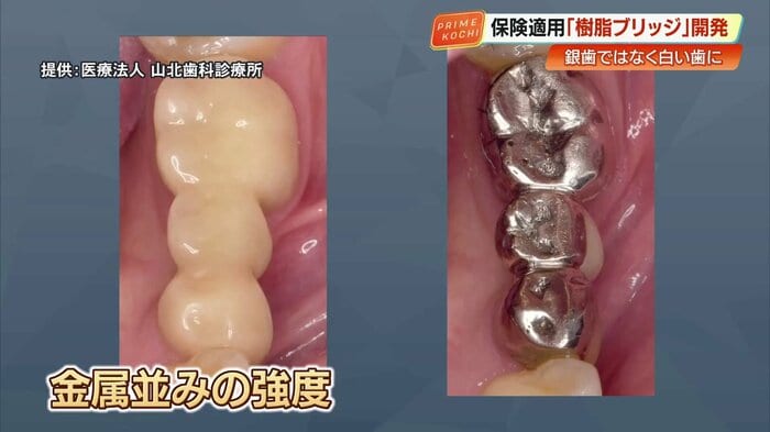 従来の銀歯と「シンボー」の比較