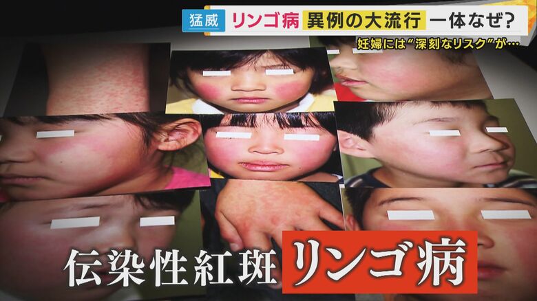 異例の流行「リンゴ病」　潜伏期間長く感染拡大に　妊娠中の感染で流産リスクも　感染対策は｜FNNプライムオンライン