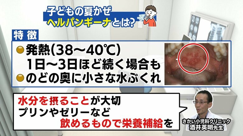 つばを飲み込めないほどの痛さ　脱水症状に注意