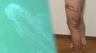 ハブクラゲに刺され一時意識不明の女児…痛々しい触手の跡 心にも大きな傷　事前に被害報告もビーチ管理側から注意喚起なし【沖縄発】