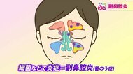 「痰が絡む人の半数は副鼻腔炎」実は虫歯が引き金になることも…放置すると髄膜炎のリスク　異変を感じたら鼻うがい、早期受診を