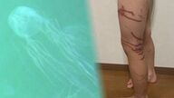 ハブクラゲに刺され一時意識不明の女児…痛々しい触手の跡 心にも大きな傷　事前に被害報告もビーチ管理側から注意喚起なし【沖縄発】