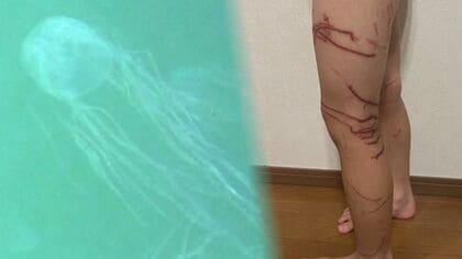 ハブクラゲに刺され一時意識不明の女児…痛々しい触手の跡 心にも大きな傷　事前に被害報告もビーチ管理側から注意喚起なし【沖縄発】