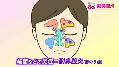 「痰が絡む人の半数は副鼻腔炎」実は虫歯が引き金になることも…放置すると髄膜炎のリスク　異変を感じたら鼻うがい、早期受診を