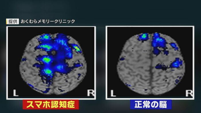 「スマホ認知症」(左図)脳機能低下を示す青い領域が多い