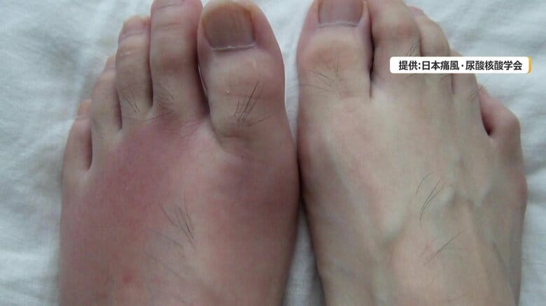 歩行困難になることも