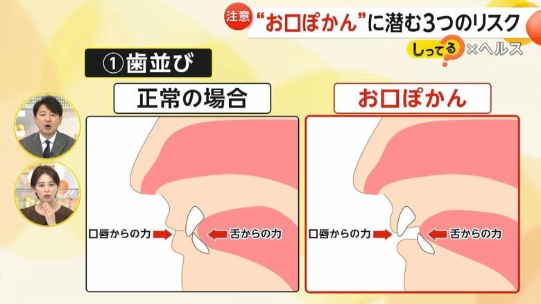 お口ぽかんが歯並びに与える影響