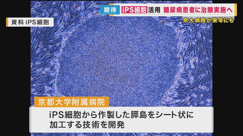 1型糖尿病の治療に期待　iPS細胞から膵島細胞をシート状に加工　京大病院が治験へ　2030年以降に実用化目指す｜FNNプライムオンライン
