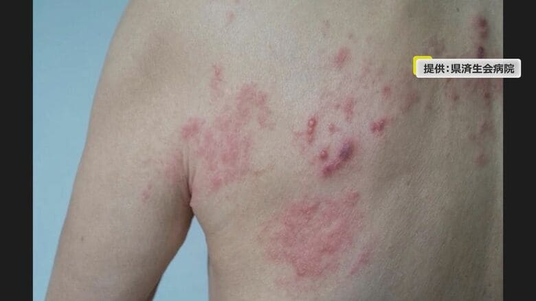 帯状疱疹（提供：福井県済生会病院）