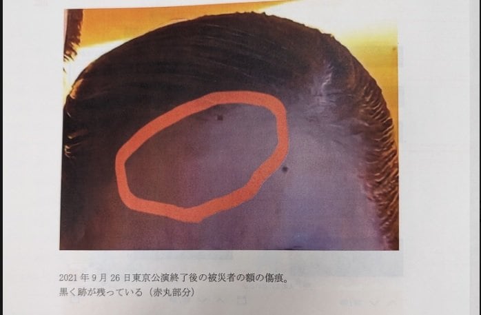 遺族側が公開した女性の額のやけどの写真