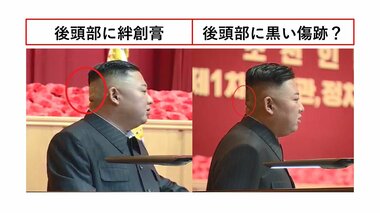 後頭部に巨大な絆創膏ベタリ…健康不安説くすぶる金正恩氏の“韓流”封じ込め作戦