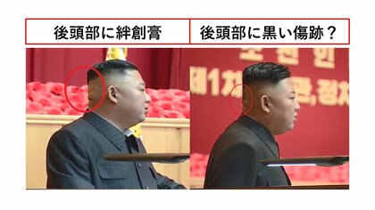 後頭部に巨大な絆創膏ベタリ…健康不安説くすぶる金正恩氏の“韓流”封じ込め作戦