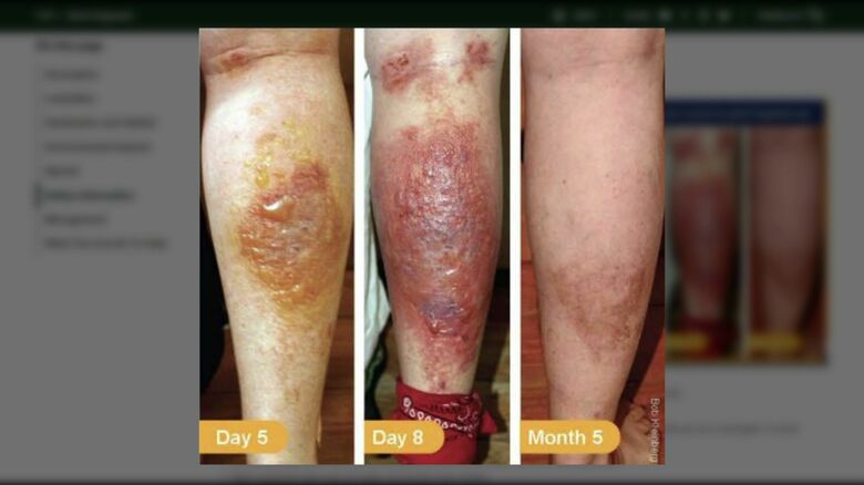 過去の皮膚炎の例（ニューヨーク州HPより）