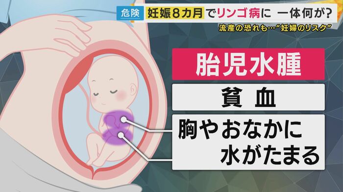 「胎児水腫」