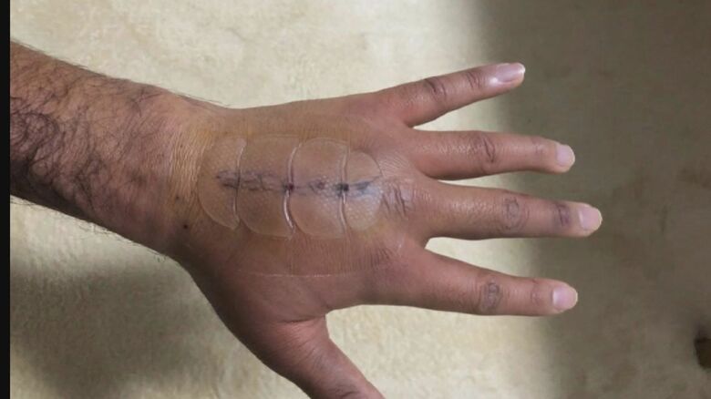 東京五輪1年半前に試合中に左手中指を骨折（写真提供：藤井さん）