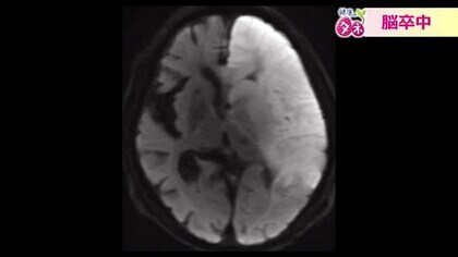 “発症から4時間半”がターニングポイントに　日本人の死因4位「脳卒中」　見逃さないための3つの初期症状