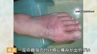 「救急車呼ぶぐらいの痛み」 夏に注意したい“痛風発作”　歩くのが大変なほど足の指が腫れる　予備軍1000万人以上とも