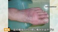 「救急車呼ぶぐらいの痛み」 夏に注意したい“痛風発作”　歩くのが大変なほど足の指が腫れる　予備軍1000万人以上とも