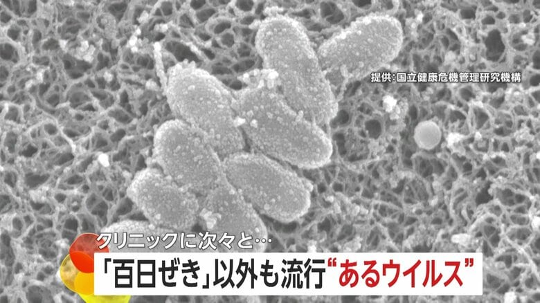 「百日咳患者」子供中心に過去最多更新する一方、大人にも強い感染力「アデノウイルス」流行に要注意…アルコール消毒効きにくく特効薬なし風呂で感染も｜FNNプライムオンライン