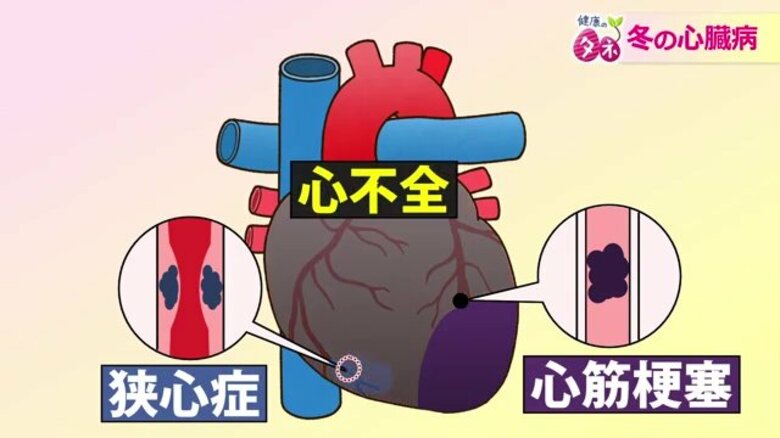 死亡率が夏の1.5倍 冬の「寒暖差」が心臓を襲う 健康づくりのウォーキングも…冷え込む早朝はリスク大 生活習慣の見直しを|FNNプライムオンライン