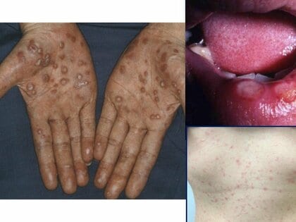 「梅毒」はキスやコップからも感染　“患者数”初の1万人超え…治療は「注射1回」で可能に