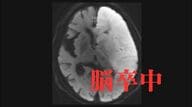 脳卒中は“発症から4時間半”がターニングポイント　早期治療につなげるための3つの初期症状と地域医療を支える情報共有システム