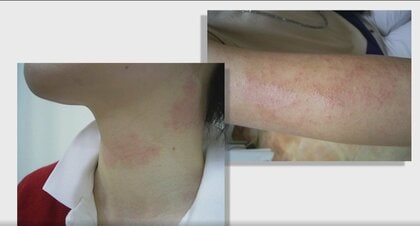 春先の急な“日差し”と“乾燥”が引き起こす「日光過敏症」。皮膚科医が推奨する予防法と骨健康のための1日20分の“日光浴”