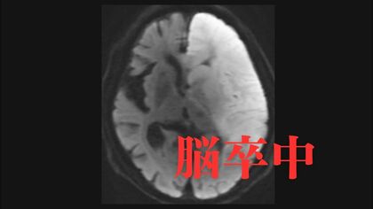 脳卒中は“発症から4時間半”がターニングポイント　早期治療につなげるための3つの初期症状と地域医療を支える情報共有システム