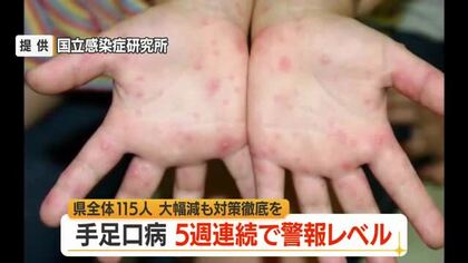 5週連続で警報レベル・手足口病の患者数115人（前週比-200人）　5歳以下の子ども中心に流行　山形